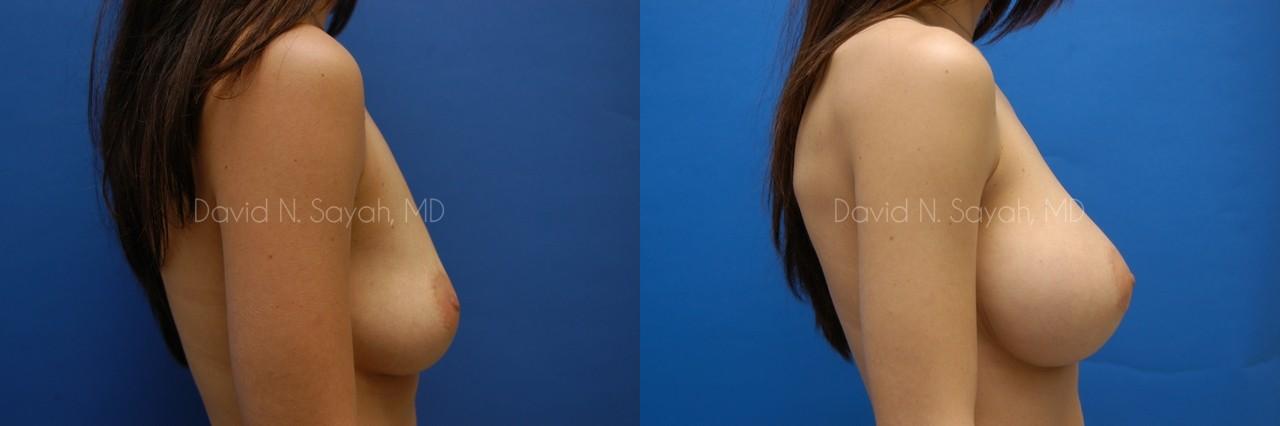 Breast Augmentation Before and After | Sayah Institute