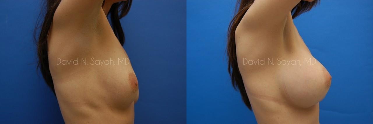 Breast Augmentation Before and After | Sayah Institute