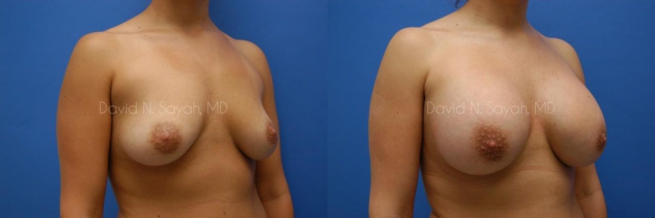 Breast Augmentation Before and After | Sayah Institute