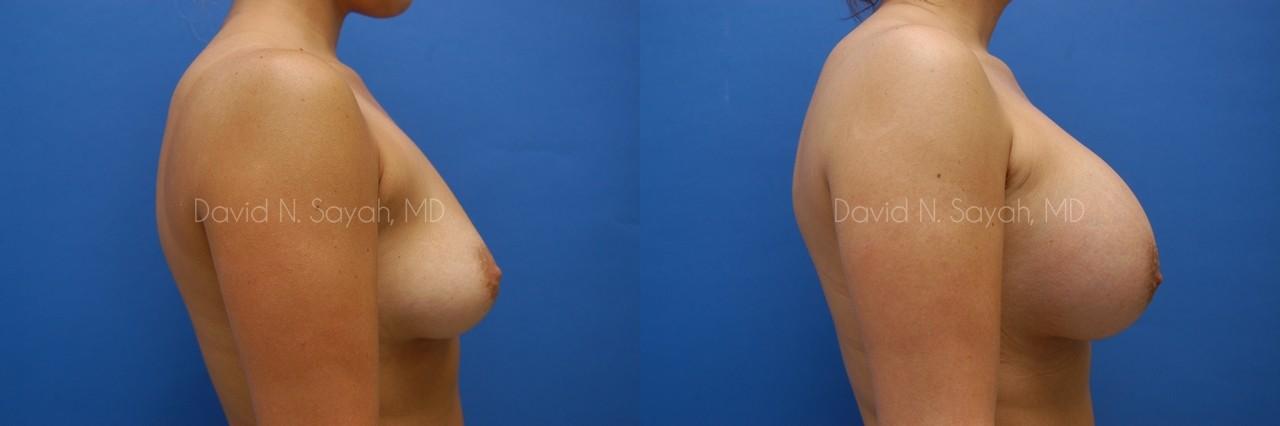 Breast Augmentation Before and After | Sayah Institute