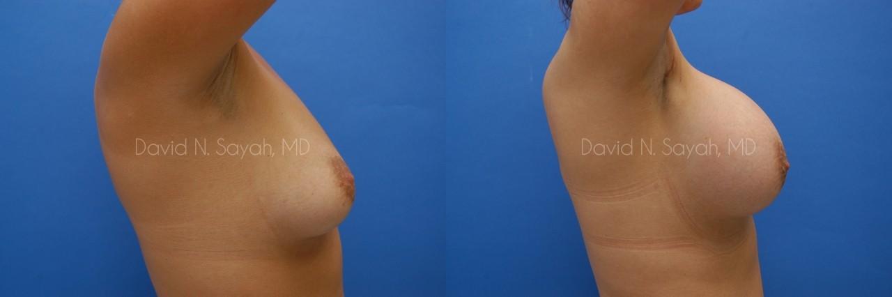 Breast Augmentation Before and After | Sayah Institute