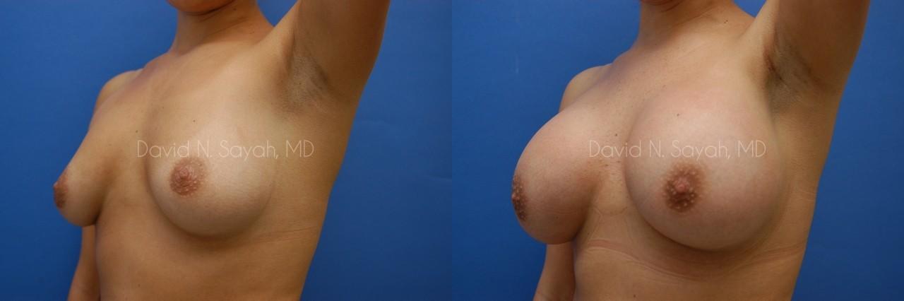 Breast Augmentation Before and After | Sayah Institute