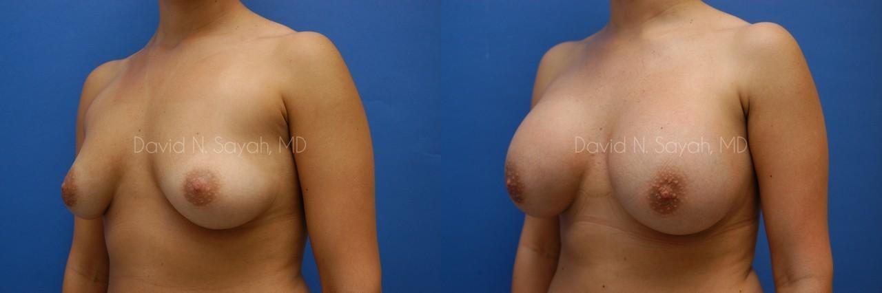 Breast Augmentation Before and After | Sayah Institute