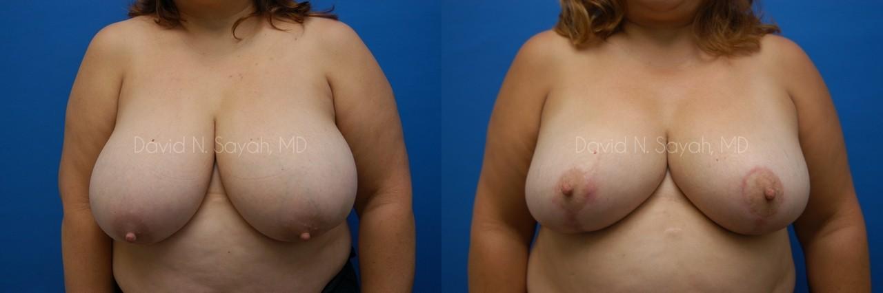 Breast Reduction Before and After | Sayah Institute