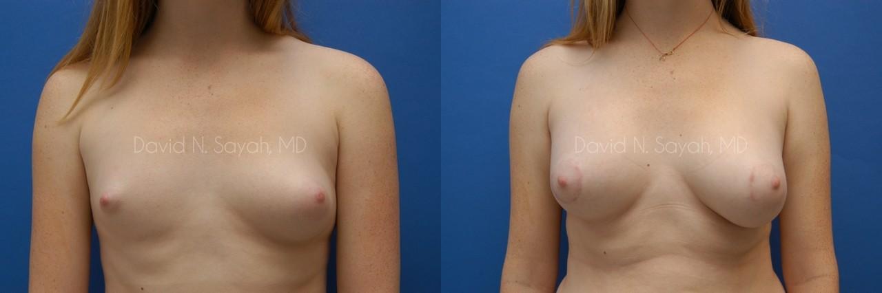 Breast Reconstruction Before and After | Sayah Institute