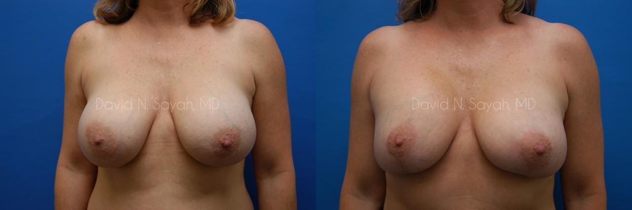 Breast Augmentation And Mastopexy Before and After | Sayah Institute
