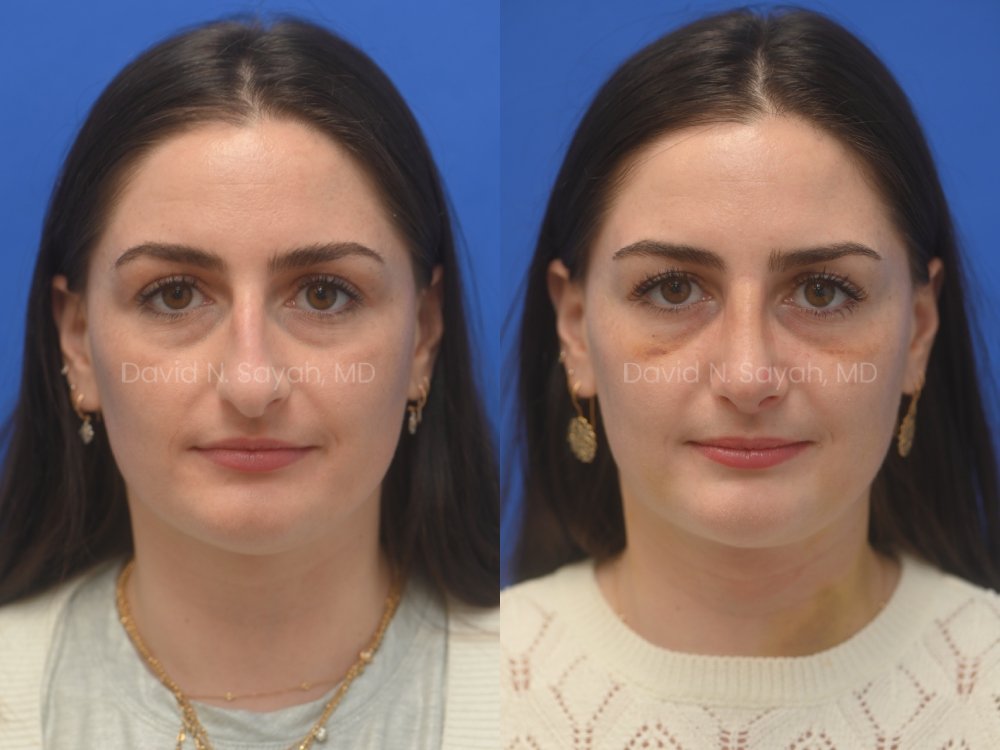 Side-by-side photos of a woman facing forward, showing her before (left) and after (right) a cosmetic procedure, with a neutral expression.
