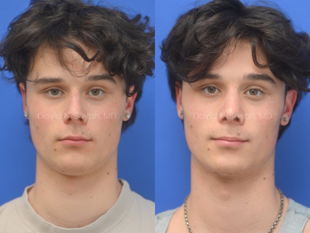 Side-by-side profile photos of a young man against a blue background, showing the nose before and after rhinoplasty and septoplasty, front view.