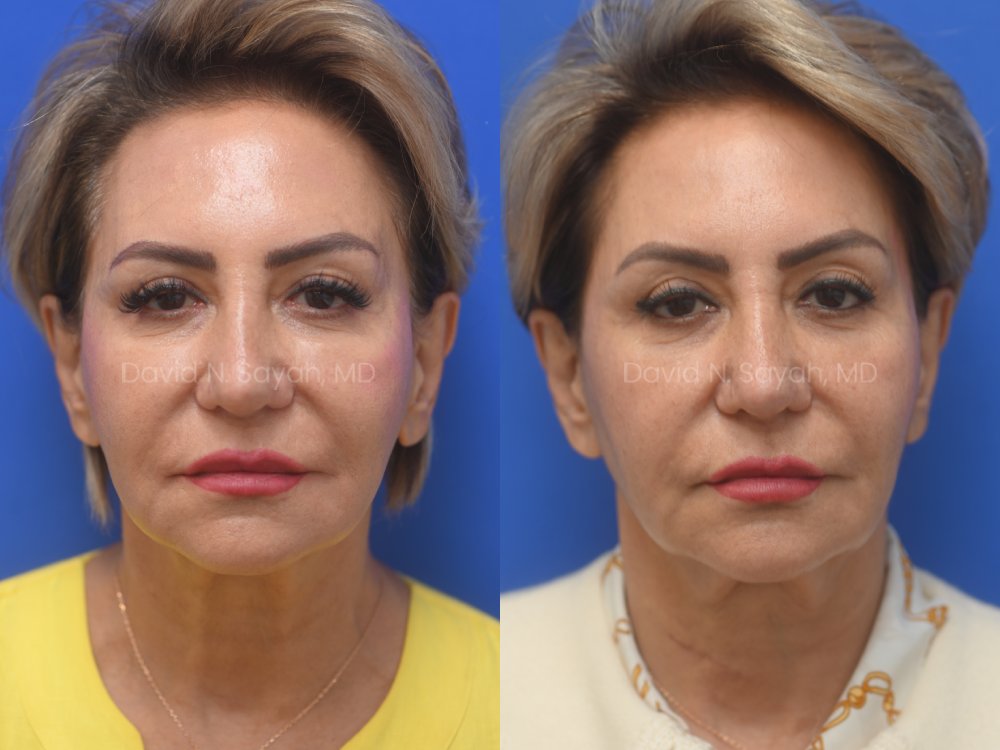 Side-by-side photos of a woman before and after a cosmetic procedure, showing changes in facial features and skin texture against a blue background.