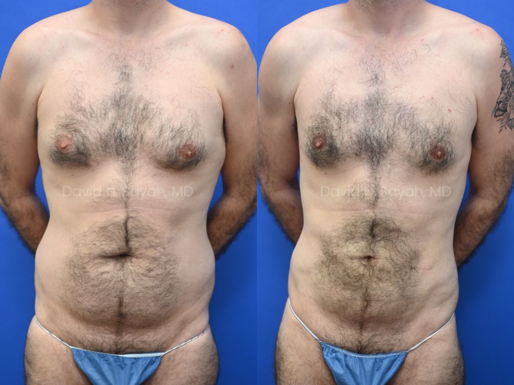Liposuction and Male Breast Surgery Before and After | Sayah Institute