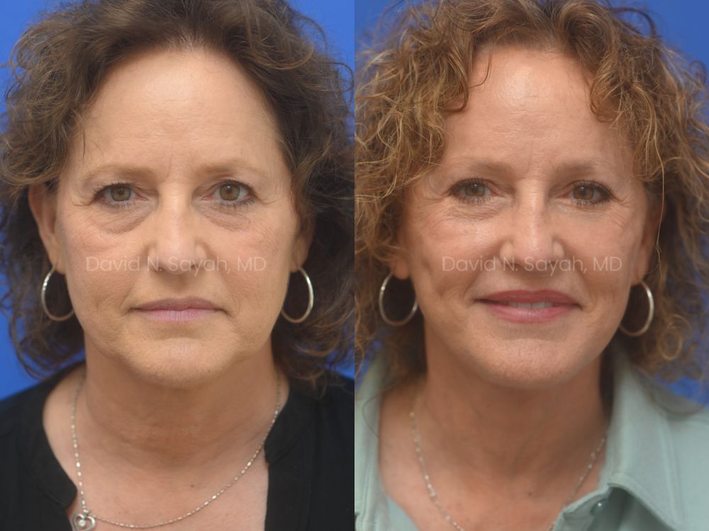 Facelift, Necklift Before and After | Sayah Institute, front view